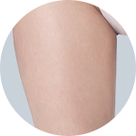 Liposuction result 4