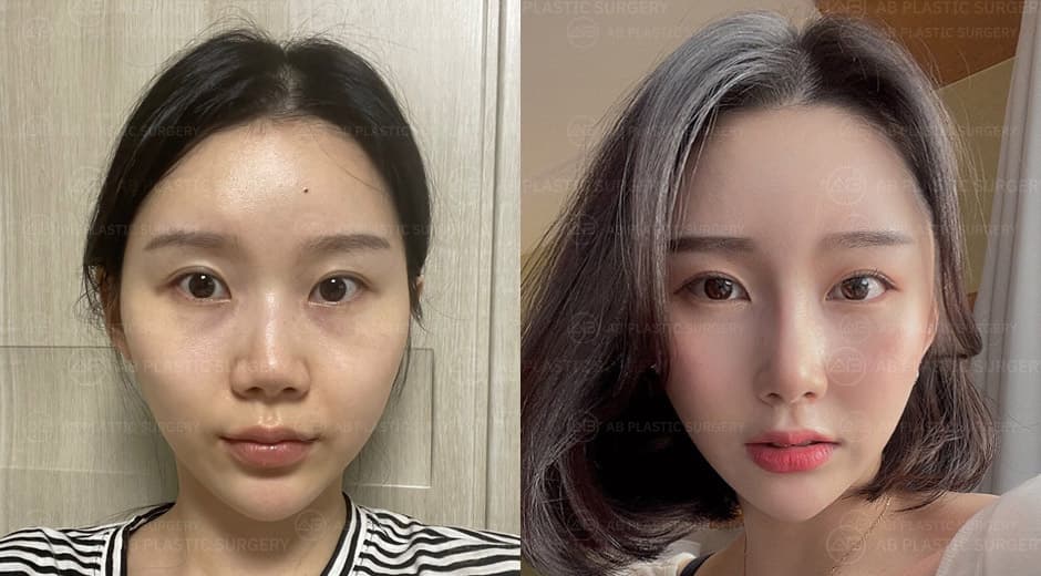 After double eyelid surgery, I don't have to wear heavy eye make up anymore.