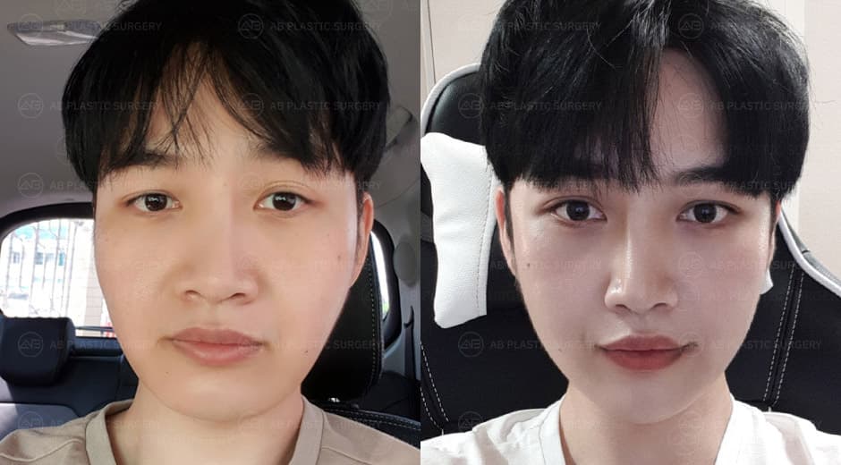 I'm so happy because there isn't a single scar mark left.