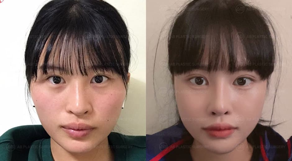 I can't believe I didn't do the plastic surgery earlier. I think I made the right decision, and I'm very satisfied with the results.